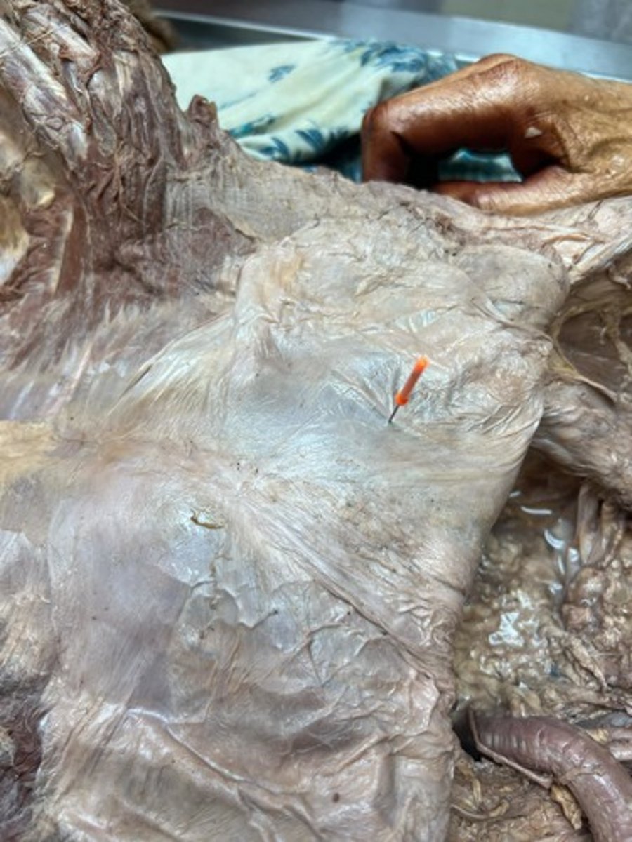 <p>inferior epigastric artery</p>