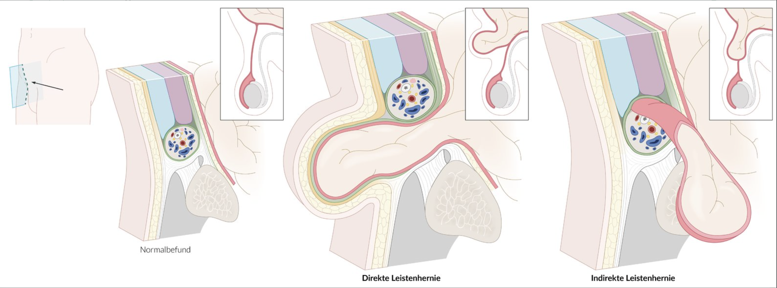<p>D. Medial inguinal fossa (Fossa inguinalis medialis)</p>