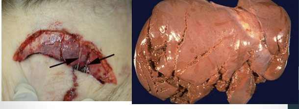<p><span>irregular edges, hair bulbs crushed, less hemorrhage, wound bridging, varying depth</span></p>