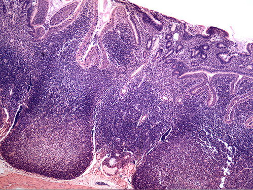 <p><span>This photomicrograph illustrates</span><br><span><strong>diffuse</strong> lymphatic tissue called peyer's patches in the wall of the intestinal tract.</span></p>