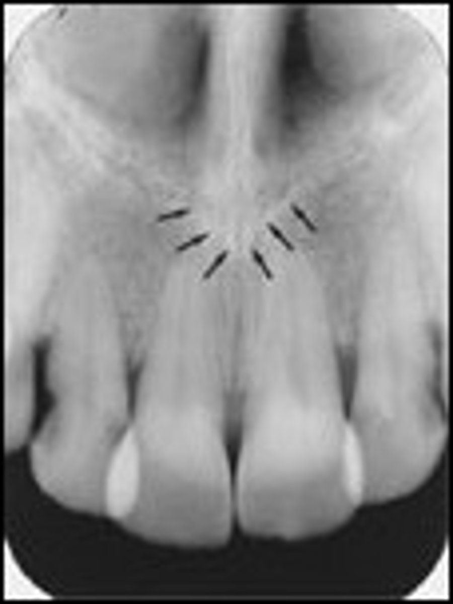 <p>Radiopaque V-shaped structure above maxillary central incisors</p>