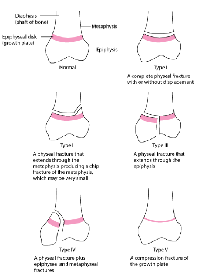 <ul><li><p><strong>Salter-Harris classification</strong></p><ul><li><p>used to classify fractures in young growing dogs. Specifically adressing injuries to the growth plate (epiphyseal disc) and is crucial for understanding implications of such fracturs on growth and development of bones in young animals. </p></li></ul></li><li><p><strong>Types of fractures: </strong></p></li><li><p>Type I: complete physial fracture with/without displacement</p></li><li><p>Type II: Physeal fracture, extending through metaphysis, making a chip fracture of metaphysis (small)</p></li><li><p>Type III: physeal fracture extending through epiphysis</p></li><li><p>Type IV: physeal fracture + epiphyseal and metaphyseal</p></li><li><p>Type  V: compression fracture of growth plate</p></li></ul><p></p>