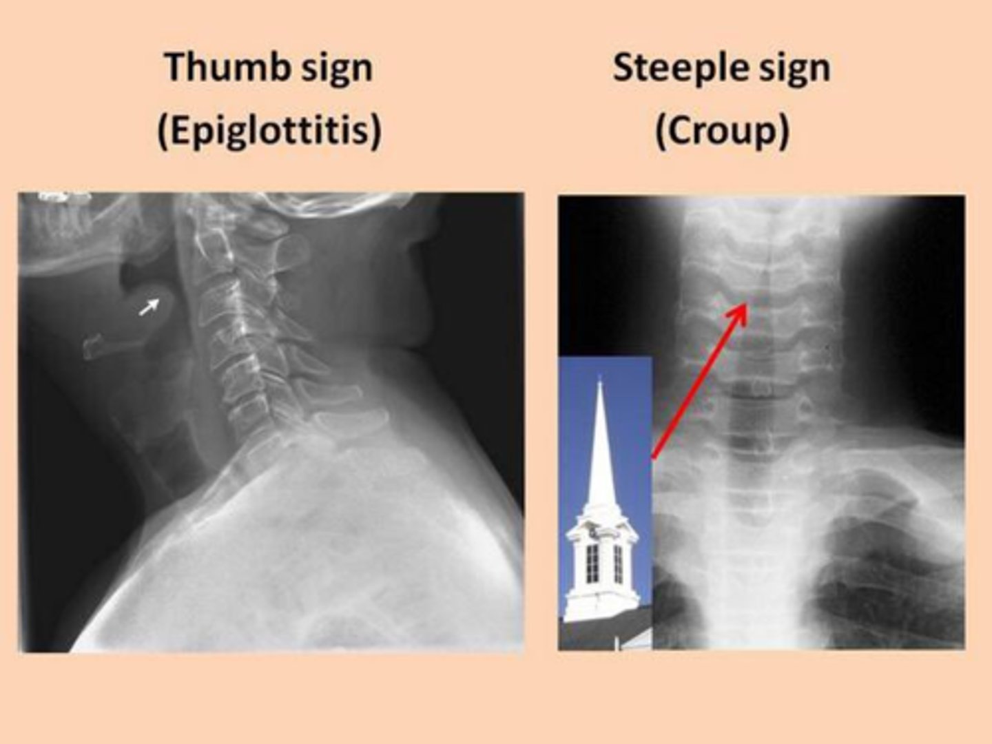 <p>Subglottic stenosis or narrowing of the opening below the vocal folds is a classic sign of croup.</p>