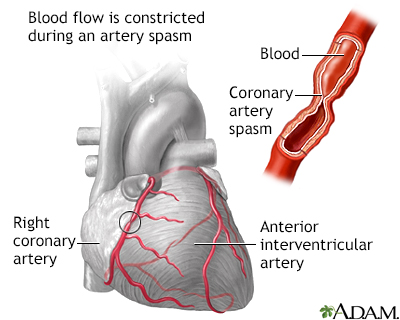 <p><strong>Coronary Artery Vasospasm</strong> is a sudden constriction of the coronary arteries, leading to <strong>reduced blood flow to the heart muscle</strong>. It can cause chest pain (angina) or even a heart attack if severe.</p>