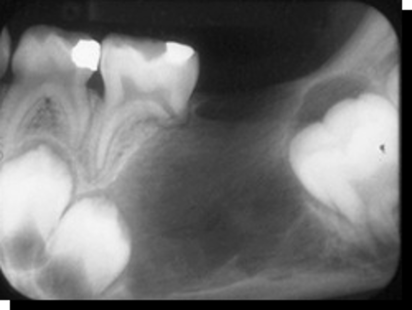 <p>benign tumors have what affect on teeth?</p>