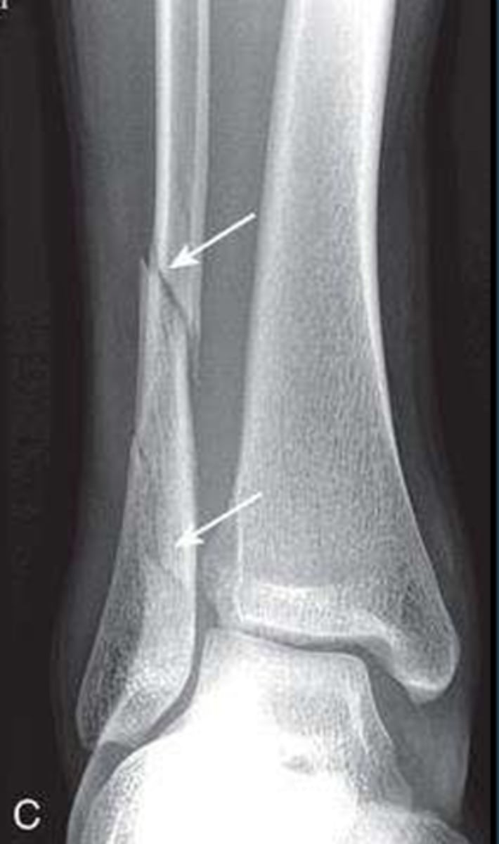 <p>What type of fracture is this?</p>