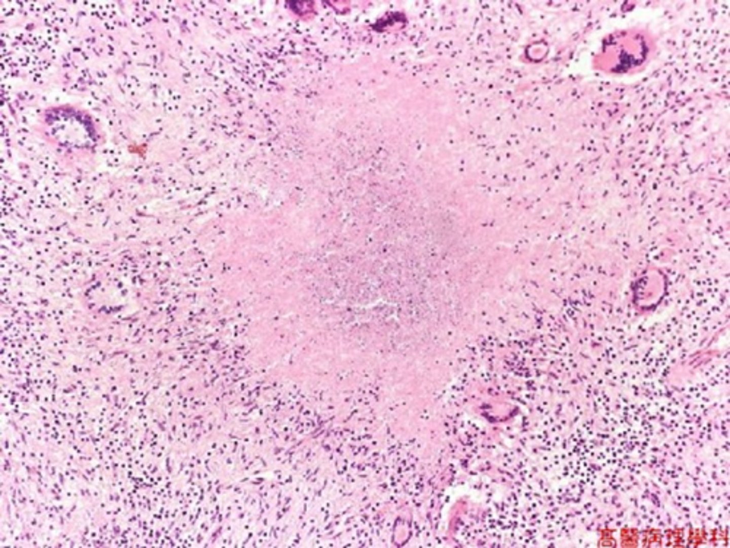 <p>collection of fragmented or lysed cells, amorphous granular debris enclosed within distinctive inflammatory border (granuloma)</p>