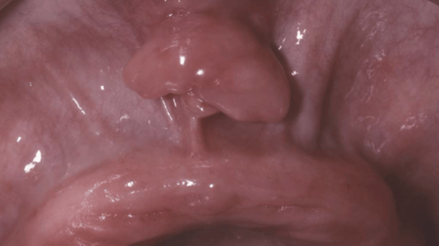 <p>Patient reported that they stopped wearing their dentures because they were painful. What do you suspect?</p>