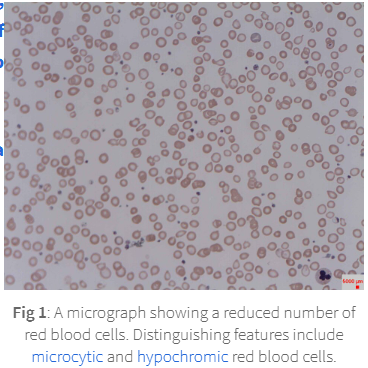 <p>leading to small (microcytic) pale (hypochromic) RBC less capable of carrying oxygen</p>