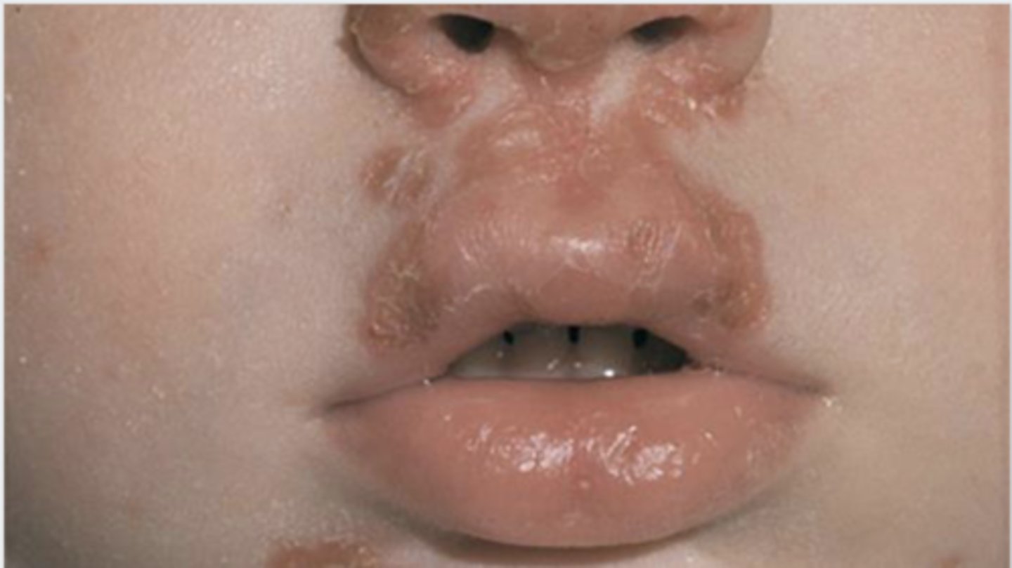 <p>impetigo</p>