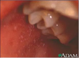 <p>A pt presents with full body rash, hacking cough, runny nose, high fever, watery red eyes, koplik’s spots (small red spots with blue white centers that appear inside the mouth). What is this pt suffering from?</p>