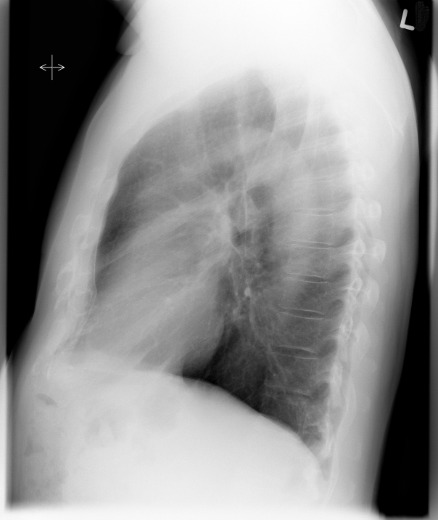 <p>Stacked posterior ribs, open intervertebral joints, and aligned hemidiaphragms. (Image shows tilt away from IR)</p>