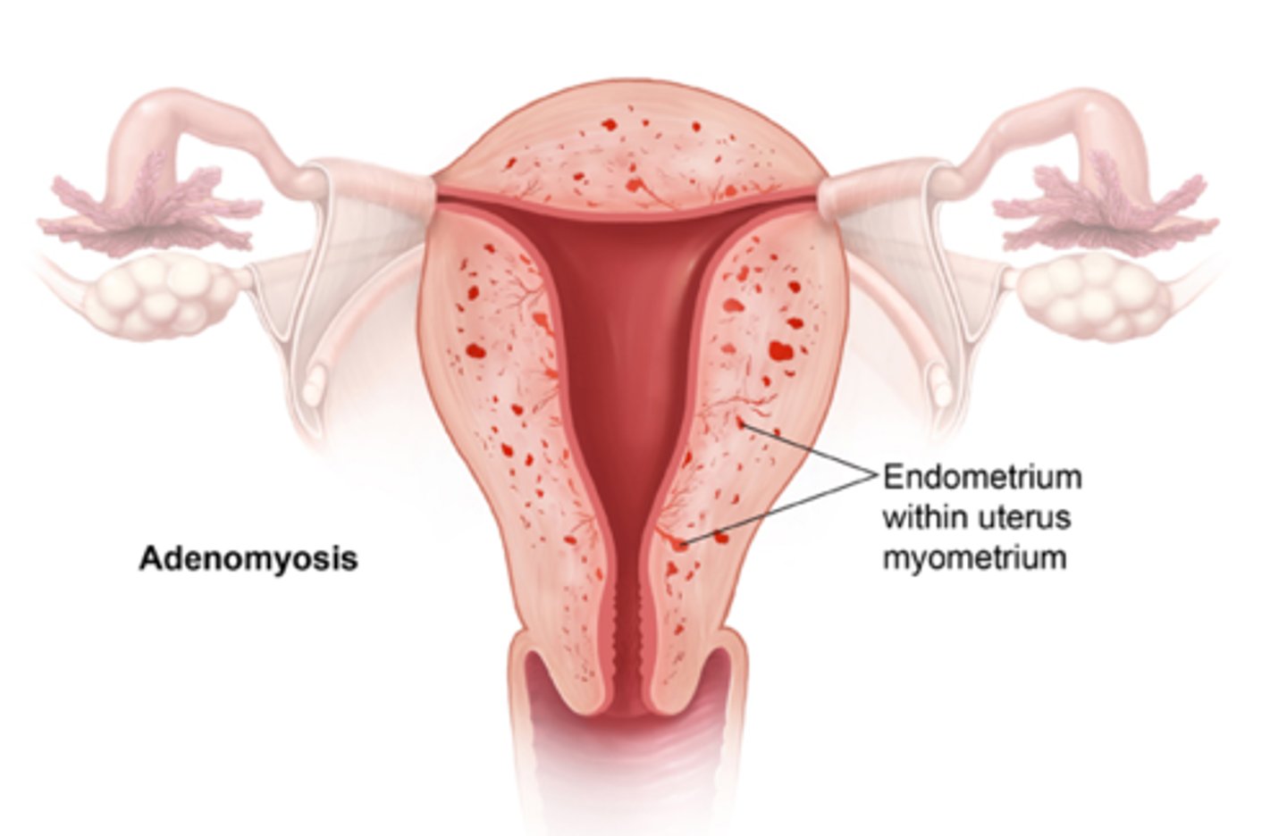 <p>growth of endometrium into the muscular portion of the uterus</p>