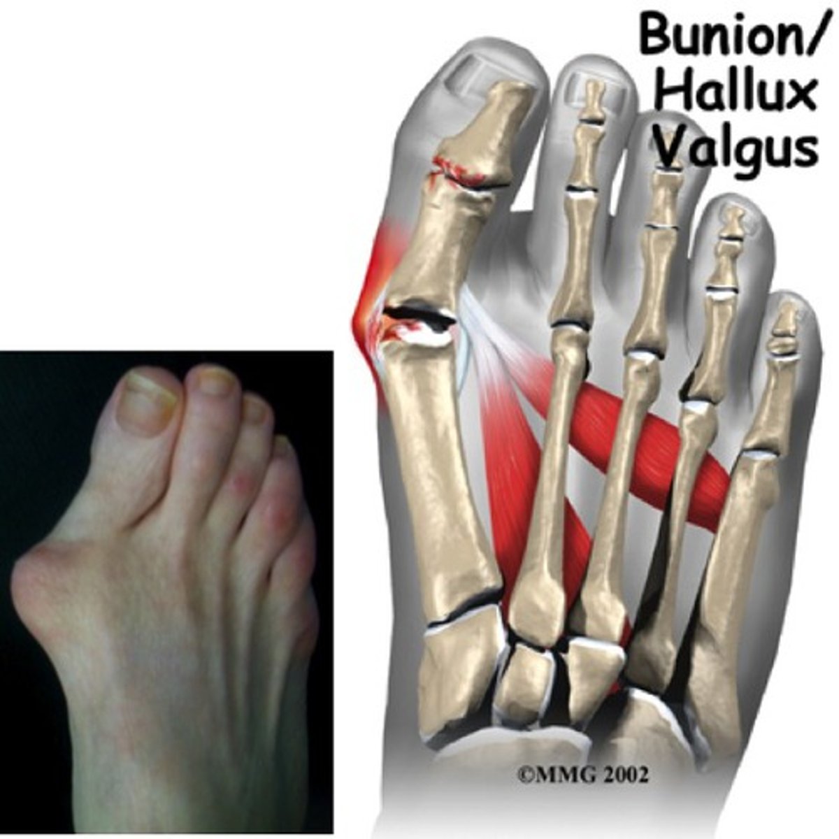 <p>lateral deviation of the great toe w/ medial deviation of the 1st metatarsal</p><p>- associated conditions: calluses or hammer toe</p>