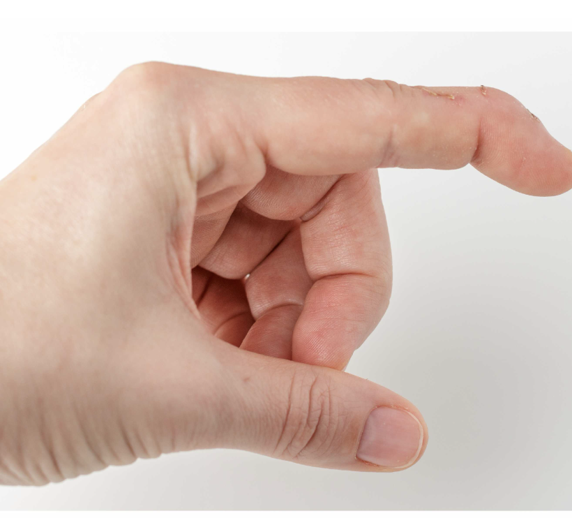 <p>What is the deformity seen in the picture below? </p>