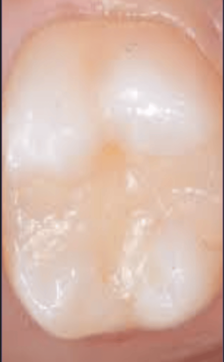 <p>- Varying shades of radiolucency depending on material</p><p>- Can sometimes mimic decay</p><p>- &gt; Older</p>