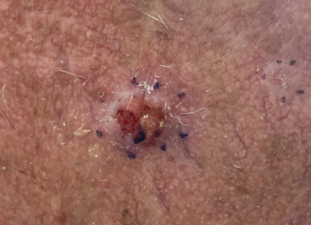 <ul><li><p>Very slow growing</p></li><li><p>Local destruction can occur</p></li><li><p>Usually painless and ulcerates </p></li></ul><ul><li><p>Flesh coloured nodules with central <span style="background-color: transparent;">depression</span>, pearly surface, rolled edge, and telangiectasia</p></li><li><p>They can can necrose and ulcerate in the centre ('rodent ulcer)</p></li></ul><p></p>