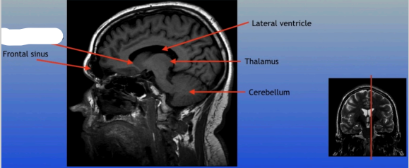 <p>A C-shaped structure within the brain's basal ganglia, involved in various functions including motor control and learning.</p>
