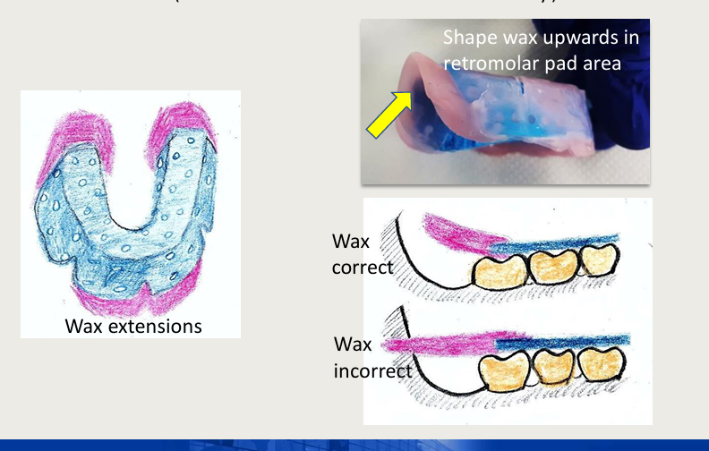 <ul><li><p>add wax in the labial sulcus and retromolar pad area (the wax must be shaped upwards to follow the normal anatomy of the area)</p></li></ul><p></p>