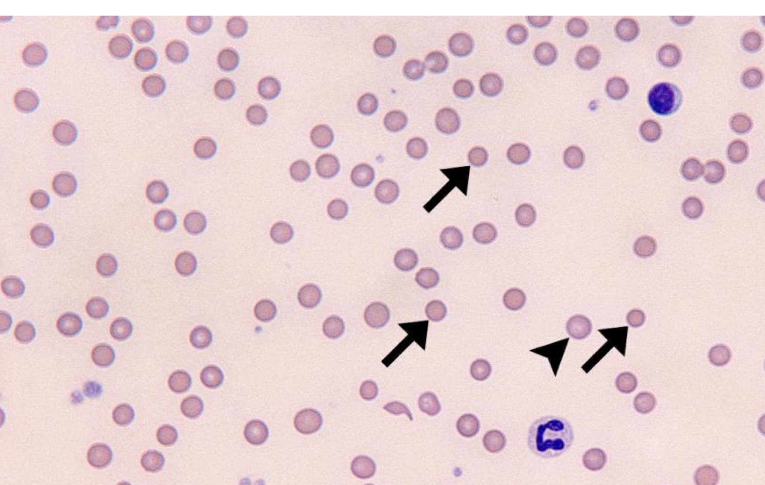Name this RBC Abnormality.