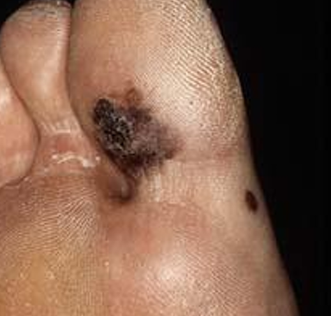 <p>hoe heet dit klinisch beeld?</p>