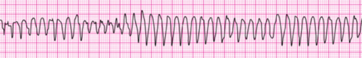 <p>This patient was admitted to the general medical ward with a history of alcoholism. A code is in progress and he has recurrent episodes of this rhythm. You review his chart. Notes about the 12-lead ECG say</p><p>that his baseline QT interval is high normal to slightly prolonged. He has received 2 doses of epinephrine 1 mg and 1 dose of amiodarone 300 mg IV so far. What would you order for his next medication?</p><p>1. Lidocaine 1 to 1.5 mg IV and start infusion 2 mg/min.</p><p>2. Repeat amiodarone 300 mg IV.</p><p>3. Repeat amiodarone 150 mg IV.</p><p>4. Give sodium bicarbonate 50 mEq IV.</p><p>5. Give magnesium sulfate 1 to 2 g IV diluted in 10 mL D5W given over 5 to 20 minutes</p>
