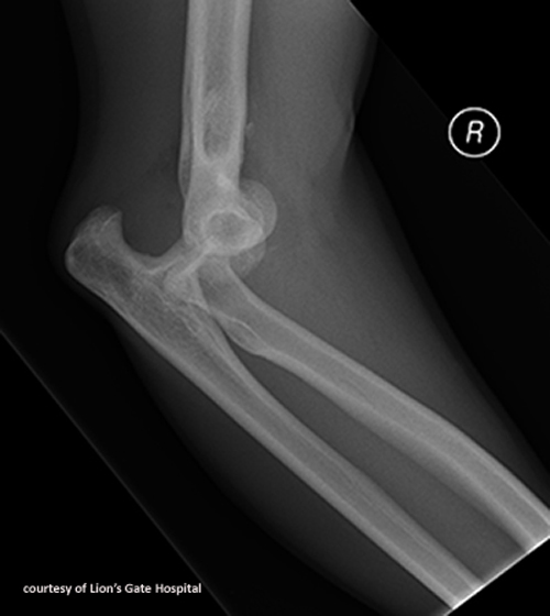 <p>FOOSH on an extended elbow; often involves coronoid process fracture.</p>
