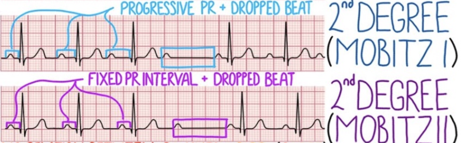 Some AP do not proceed to ventricles --> ventricular bradycardia 
Mobitz type 1: Progressive PR + dropped beats 
Mobitz type 2: Fixed PR + dropped beats 
* can be treated w/ antiarrhythmics 