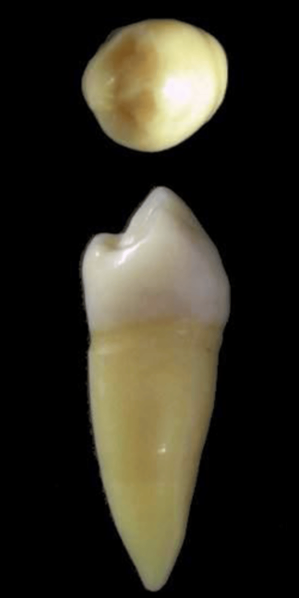 <p>what tooth is this &amp; why?</p>