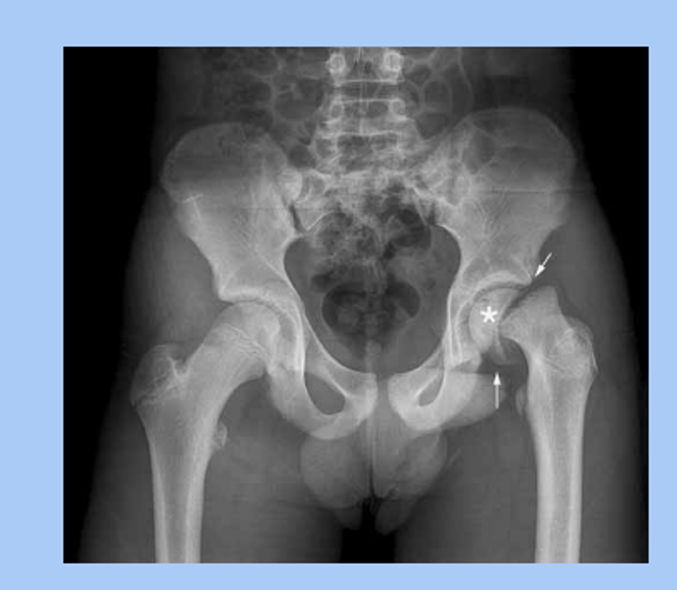 <p>-hip disorder caused by displacement of the proximal femoral epiphysis due to disruption of the growth plate </p><p>-RF: 9-16yo proceeds adolescent growth spurt, females 11.5, males 13, the big kids</p><p>-stable: bear weight</p><p>-unstable: unable to bear weight </p><p>-chronic SCFE is more common </p><p>-sx: atraumatic, pain + limp, limited internal rotation of hip</p><p>-dx: radiograph: ice cream slipping off cone </p><p>-tx: non-weight bearing on crutches, immediate referral to ortho, surgery</p><p>-development of avascular necrosis= poor prognosis </p>