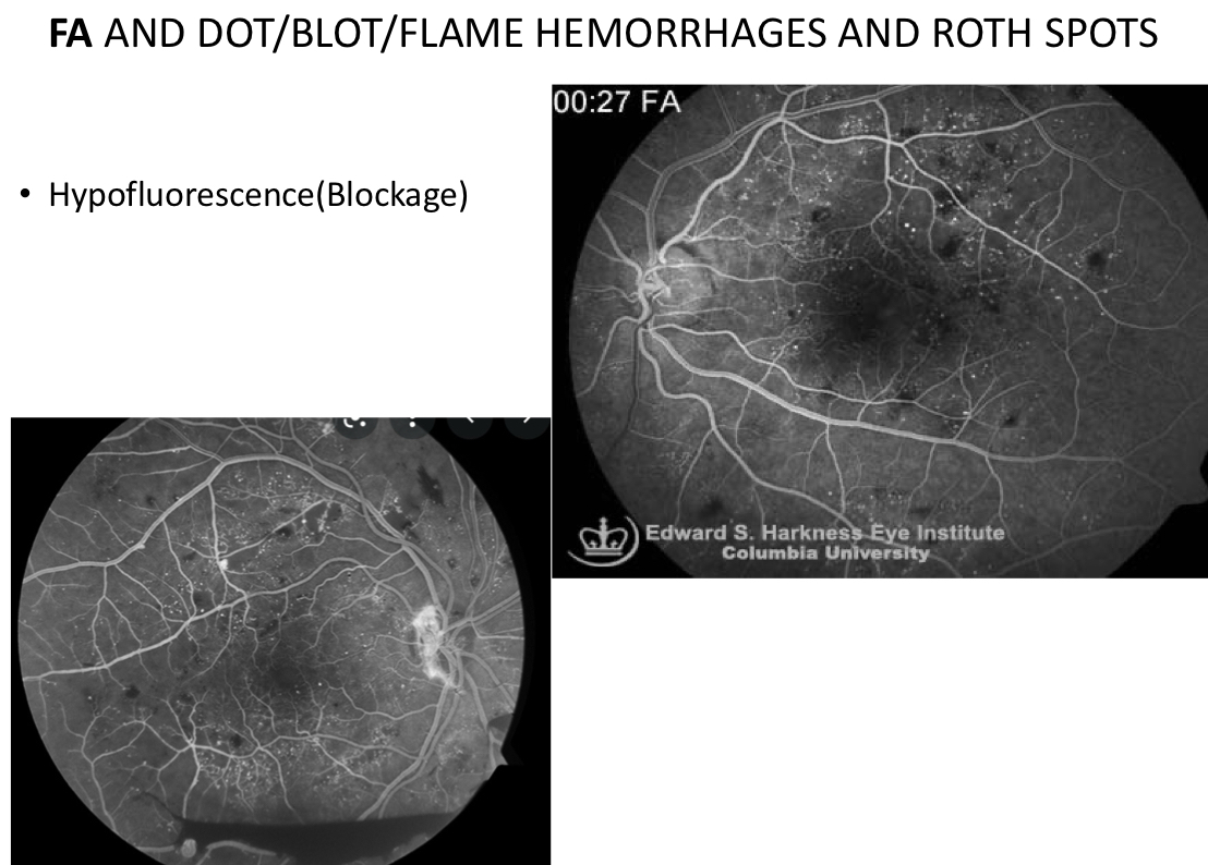 <p>hypofluorescence (blockage)</p>