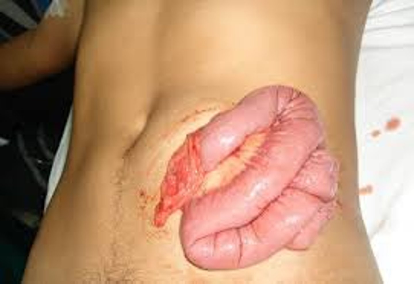 <p>opening of wound with extrusion of tissue and organs</p>