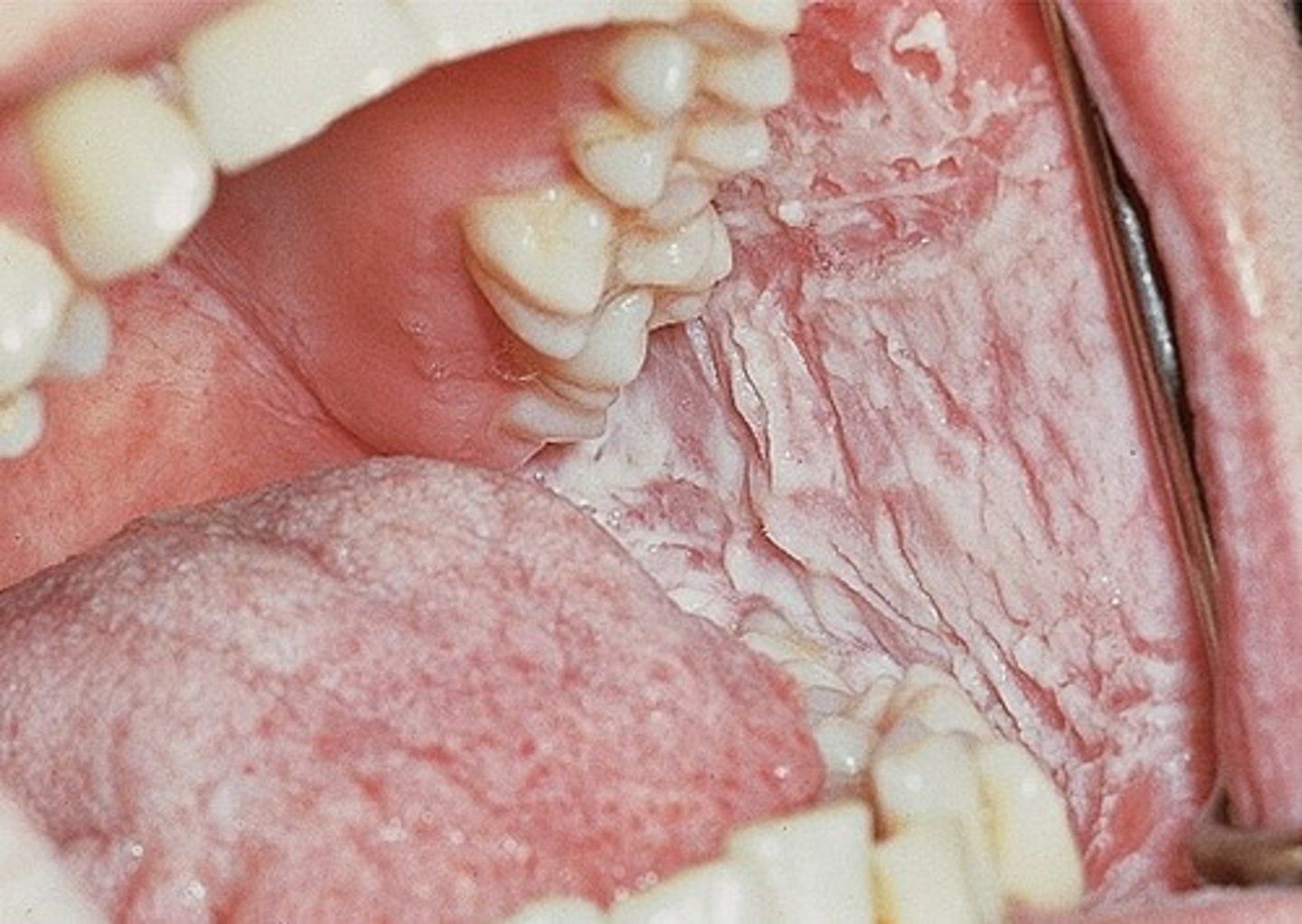 <p>genetic</p><p>• Other names: familial white folded dysplasia, cannon disease</p><p>• Population: childhood onset, children</p><p>• thick, corrugated plaques; usually bilateral</p><p>• Common location: buccal mucosa</p><p>**GINGIVA/DORSAL TONGUE NEVER AFFECTED**</p>