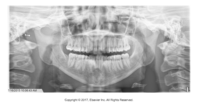 <p>A panoramic radiograph shows a large, blurry, radiopaque shape high on the left side of the image. It appears duplicated and slightly distorted. </p>
