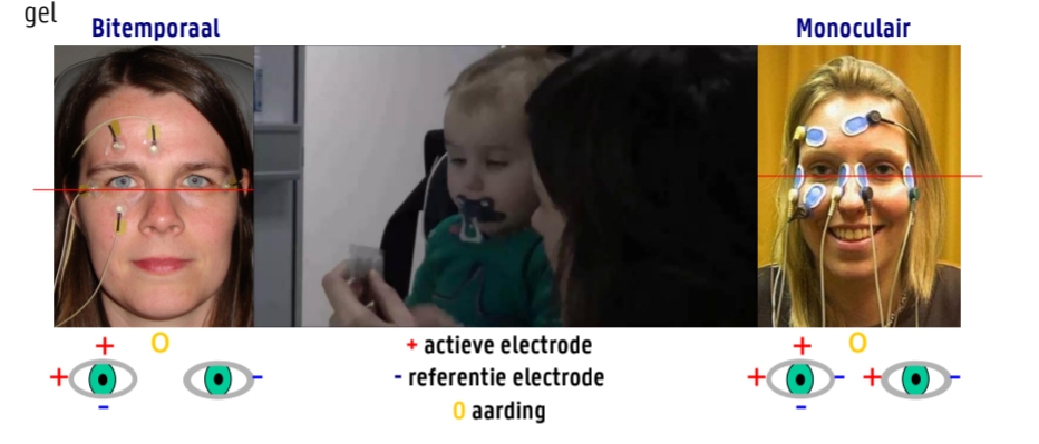 <p><strong>Voorbereiding huid:</strong></p><ul><li><p>Ontvetten met ether</p></li><li><p>Ruw maken met impedantie-verlagende, schurende (abrasieve) gel</p></li></ul><p><strong>Opmerkingen:</strong></p><ul><li><p>Bij gedysconjugeerde oogbewegingen of onvoldoende retinale doorbloeding (bv. blind aan één kant) → enkel rechter of linker oog registreren.</p></li><li><p>Meestal wordt linker opstelling gebruikt.</p></li></ul><p><strong>Principe:</strong></p><ul><li><p>Geconjugeerde horizontale oogbeweging → beide ogen bewegen gelijk → <strong>één oog meten volstaat</strong>.</p></li><li><p>Alternatief: beide ogen apart meten (rechter opstelling) of <strong>optellen</strong> voor grotere, duidelijkere potentialen.</p></li></ul><p><strong>Elektrodeplaatsing:</strong></p><ul><li><p>Links van linker oog = <strong>negatief</strong>.</p></li><li><p>Rechts van rechteroog = <strong>positief</strong>.</p></li><li><p>Aarding: boven = positief, onder = negatief.</p></li><li><p><strong>Zo dicht mogelijk bij het oog</strong> en op <strong>gelijke afstanden</strong>!</p></li></ul><p></p>