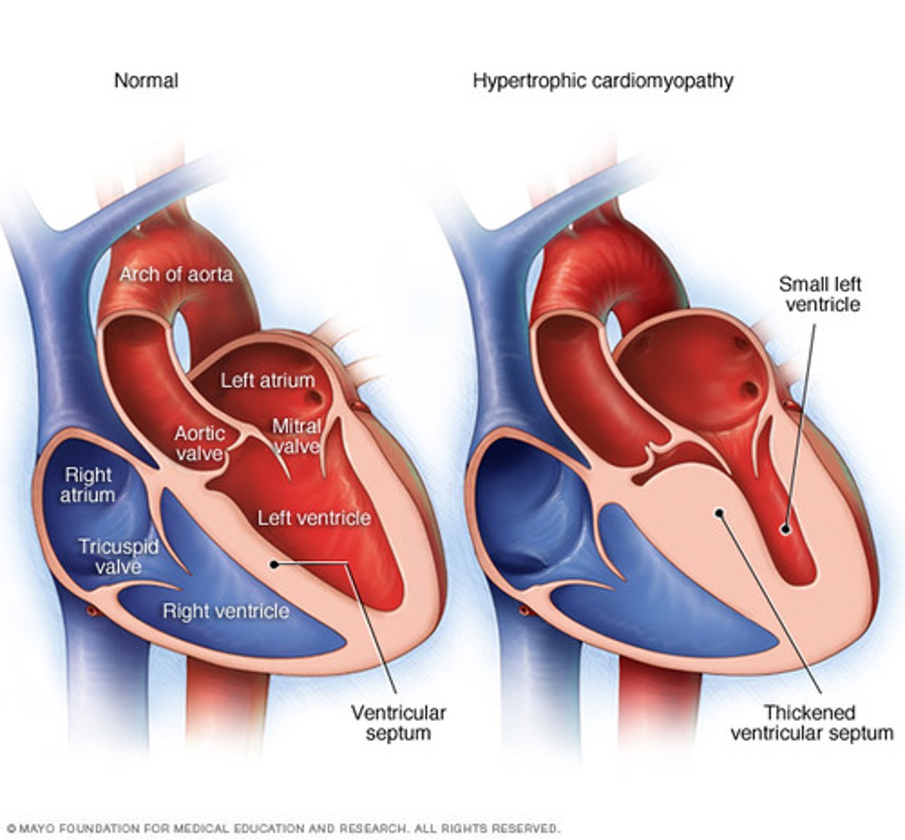 <p>Hypertrophic cardiomyopathy (HOCM)</p>