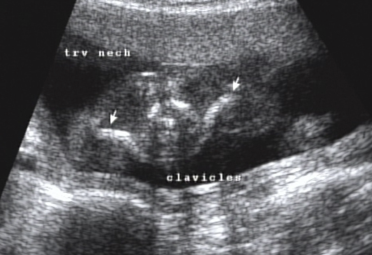 <ul><li><p>not a routinely imaged part of the body</p></li><li><p>imaged in the presence of skeletal dysplasias and other rare suspected syndromes</p></li><li><p>can be measured and used as a tool to determine GA</p></li><li><p><strong>Ossify</strong> as early as <span style="color: rgb(178, 0, 255);">8-9 weeks</span></p></li></ul><p></p>