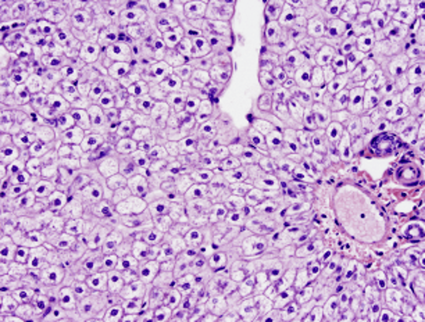 <p>What type of reversible cell injury is shown in this image?</p>