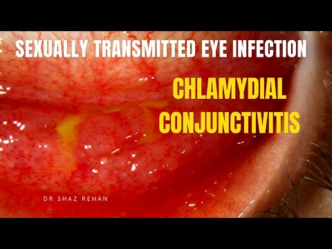 <p>Which ophthalmologic conditions can doxycycline treat?</p>