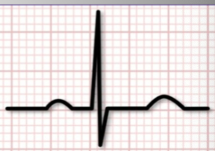 <p>examples of narrow QRS complex tachycardias </p>