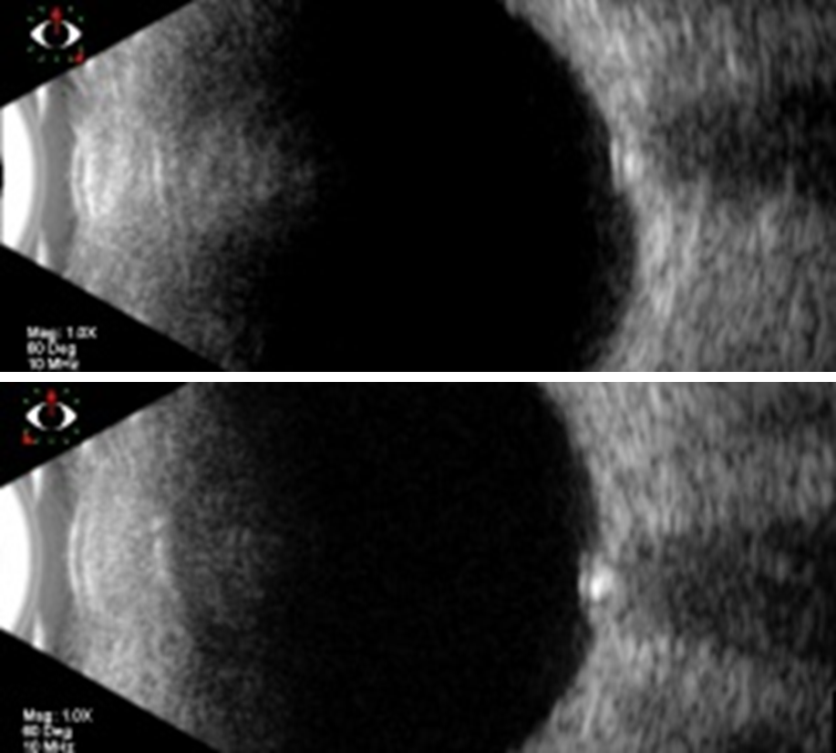 <p>What do you expect to see on B scan with ONH drusen?</p>