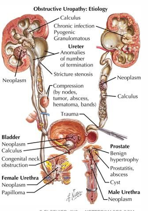 <p>-ureteral: bilateral stones, papillary necrosis, blood clots, external compression from malignancies, RP fibrosis (IgG4), iatrogenic ligation</p><p>-bladder: stones, blood clots, BPH, bladder cancer, prostate cancer, neuropathic</p><p>-urethral: stricture, phimosis</p>
