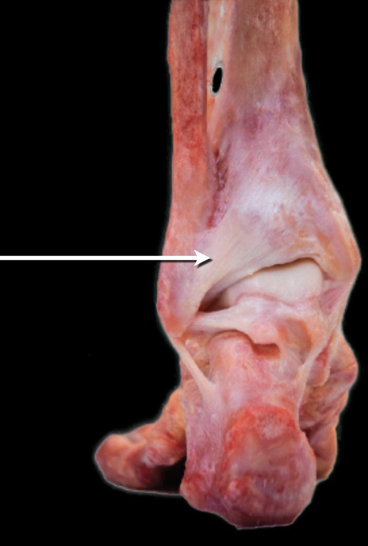 <p>What type of fibrous joint and subtype</p>