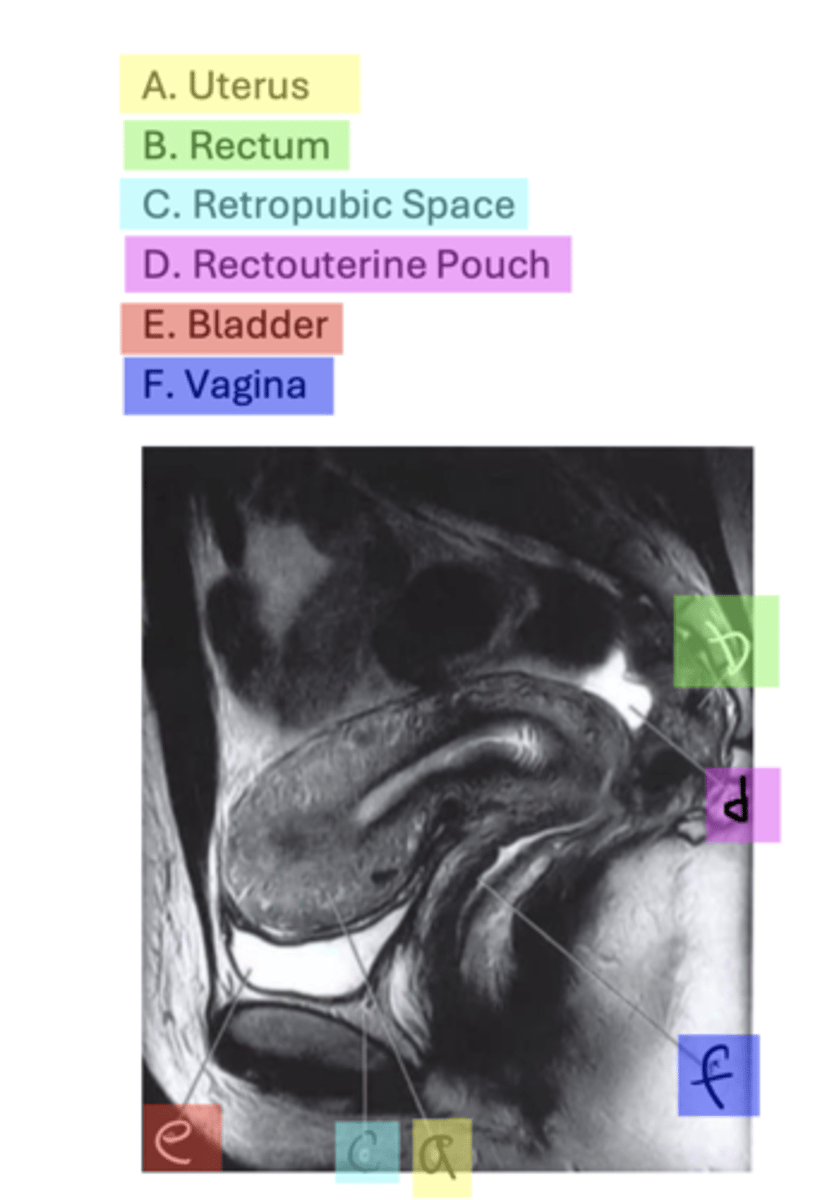 <p>A. Uterus</p><p>B. Rectum</p><p>C. Retropubic Space</p><p>D. Rectouterine Pouch</p><p>E. Bladder</p><p>F. Vagina</p>