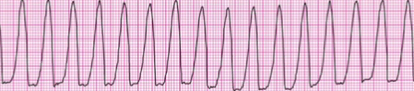 <p>- P wave is not seen</p><p>- QRS complex = wide and bizarre</p><p>- Ventricular rate ranges from 150 to 250 bpm</p><p>- Blood pressure &amp; LOC is often decreased during ventricular tachycardia -&gt; medical emergency</p><p>- With pulse -&gt; cardioversion, lidocaine, amiodarone</p><p>- Without a pulse -&gt; defib, compressions, epinephrine &amp; amiodarone</p>