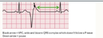 <ul><li><p>No P wave before VPC - signalment doesn’t come from SAN</p></li><li><p>broad QRS complex</p></li><li><p>QRS is abnormally shaped - wide and bizarre b/c electrical activity is originating from ventricles </p></li><li><p>pause following complex</p></li></ul><p></p>