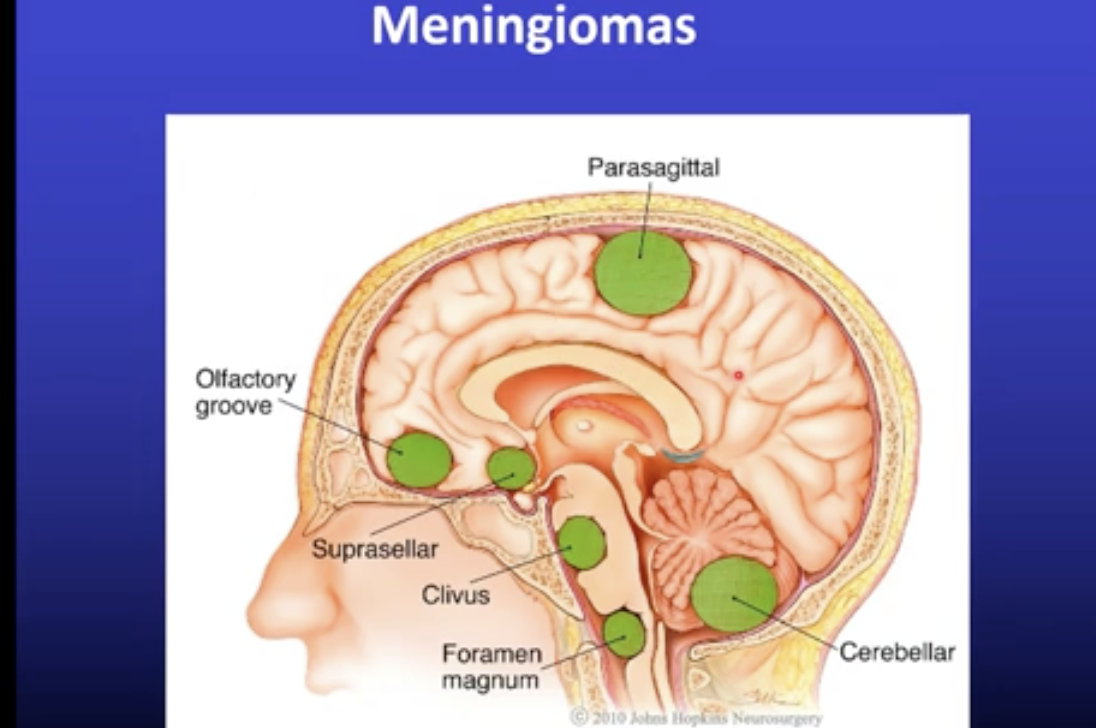 <p>Meningiomas</p><ul><li><p>Located outside the CNS</p></li><li><p>Grow slowly, few symptoms</p></li><li><p>Occur more in females because they are sensitive to oestrogen</p></li><li><p>Often benign</p></li><li><p>Can be removed surgically</p></li></ul>