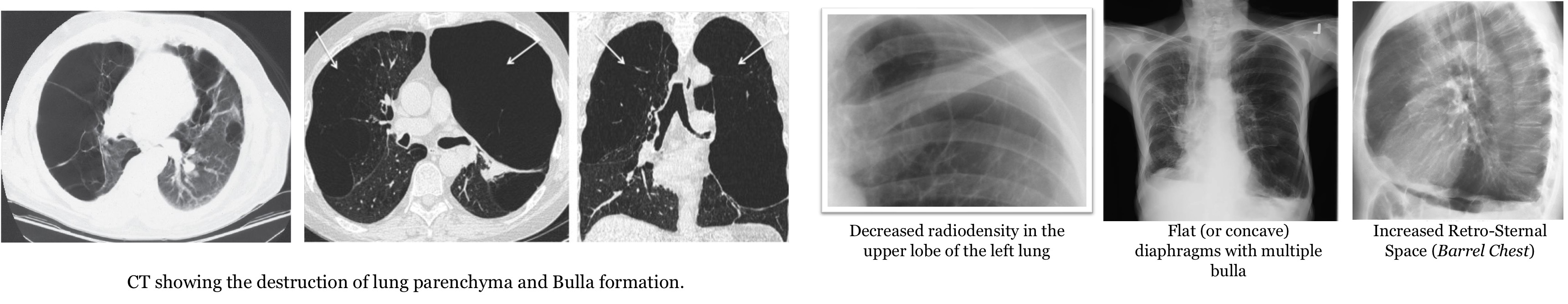 <ul><li><p>Abnormally expanded air spaces distal to terminal bronchiole with destruction of walls of involved air spaces.</p></li><li><p>The alveolar walls are destroyed trapping air in the spaces on exhalation.</p></li><li><p>Lung elastic recoil is damaged further increasing the air trapped in the lungs.</p></li></ul><p><strong>Radiological Appearance</strong></p><ul><li><p>lungs are hyperinflated, decreased radiodensity</p></li><li><p>Flat or concave diaphragms</p></li><li><p>Bullae formation: large radiolucent air containing systic spaces</p></li></ul><p></p><p></p>