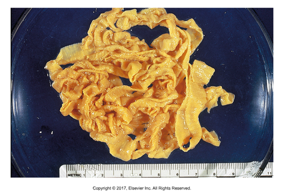 <p>“Ruminant tapeworm”</p><ul><li><p>Affects: Cattle, sheep and goats (Moniezia benedini in cattle only)​</p></li><li><p>Found in: Worldwide</p></li><li><p>Adult in small intestine​</p></li><li><p>Cause of infection: Ingestion of infected grain​</p></li><li><p>Much larger than Hymenolepis (up 1.6 cm by 6m)</p></li><li><p>Unarmed scolex​</p></li><li><p>Short, wide proglottids​</p></li><li><p>Unique eggs with square (M. benedini) or triangular (M. expansa) shells​</p></li><li><p>Three-layered egg shell, inner-most is pyriform apparatus—pear shaped​</p></li><li><p>Prepatent period: 40 days​</p></li><li><p>Eggs seen on fecal flotation</p></li></ul><p></p>