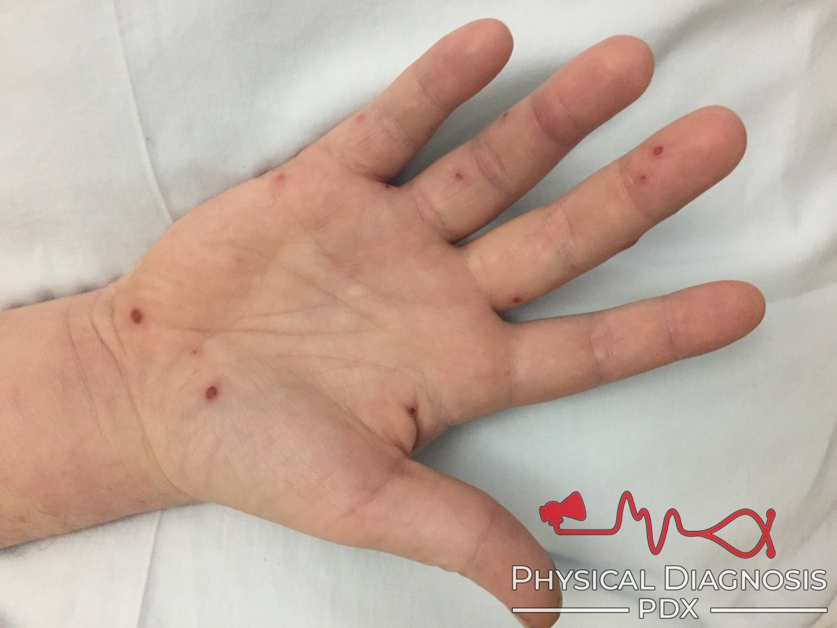 <ul><li><p><span style="font-size: inherit">tender palpable nodules</span></p></li><li><p><span style="font-size: inherit">rare, peripheral signs of<strong> infective endocarditis</strong></span></p></li><li><p><span style="font-size: inherit">noted on the finger pulps or thenar/hypothenar eminences</span></p></li><li><p><span style="font-size: inherit">thought to be </span>due to:</p><ul><li><p><strong>Septic Microemboli</strong> (tiny clots or infected material from heart valves) traveling through circulation</p><p>or</p></li><li><p><strong>Vasculitis</strong> (immune complex deposition) causing damage to capillaries</p></li></ul></li></ul><img src="https://knowt-user-attachments.s3.amazonaws.com/125f0071-ee79-4ff0-967d-3f5e14a17129.png" data-width="100%" data-align="center"><p></p>